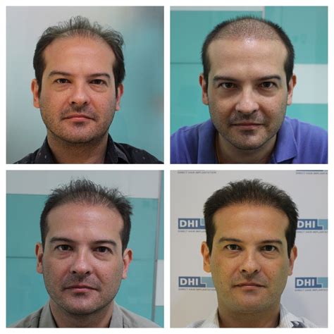 hair transplant cebu|Hair Transplant in Philippines • Check Prices & Reviews.